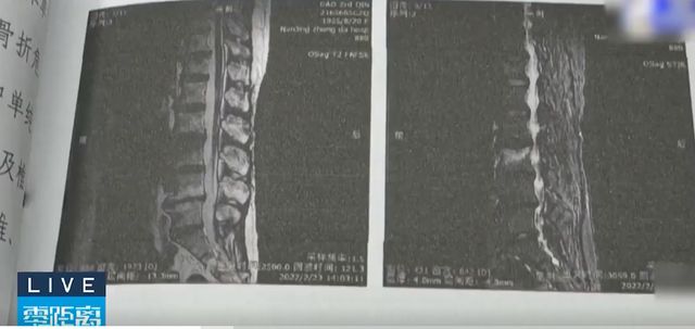 7旬老人花8万元练普BOB半岛拉提导致腰椎骨折法院：健身房存在过错(图2)