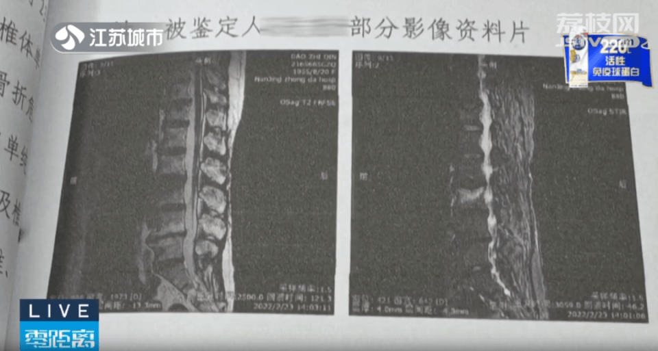 老人练普拉半岛·BOB官方网站提导致腰椎骨折！健身还需量力而行！(图3)